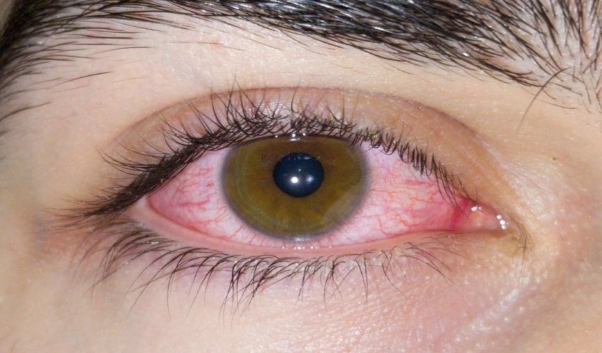 Eye Health: धूल वाली आंधी से कॉन्टैक्ट लेंस यूजर्स को रहना चाहिए ज्यादा सावधान, वरना हो सकती है दृष्टि की हानि